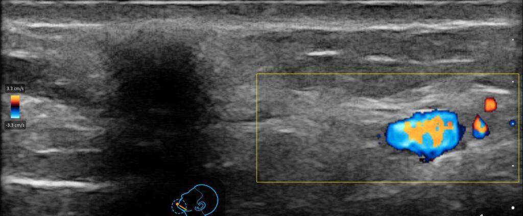 Ultrasound image showing PMMA filler with facial artery visualization to guide safe aesthetic injections.