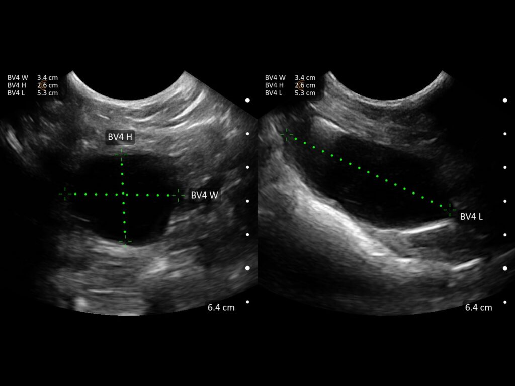 Split-screen ultrasound showing bladder volume measurements in transverse and longitudinal views with width, height, and length dimensions labeled.