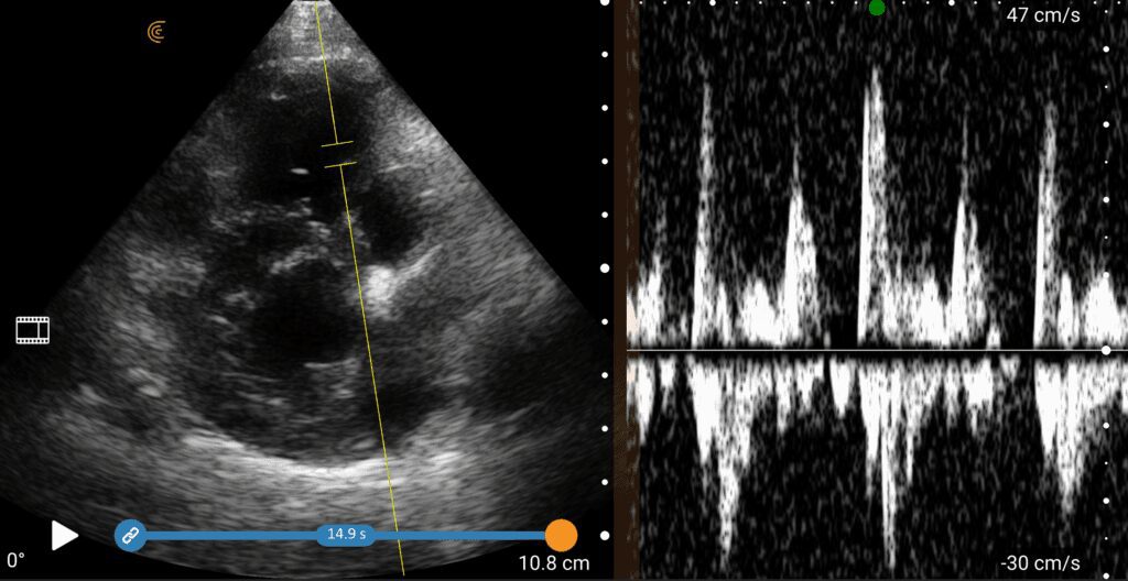 Cardiac ultrasound image with spectral Doppler showing blood flow velocity patterns across the heart valves.