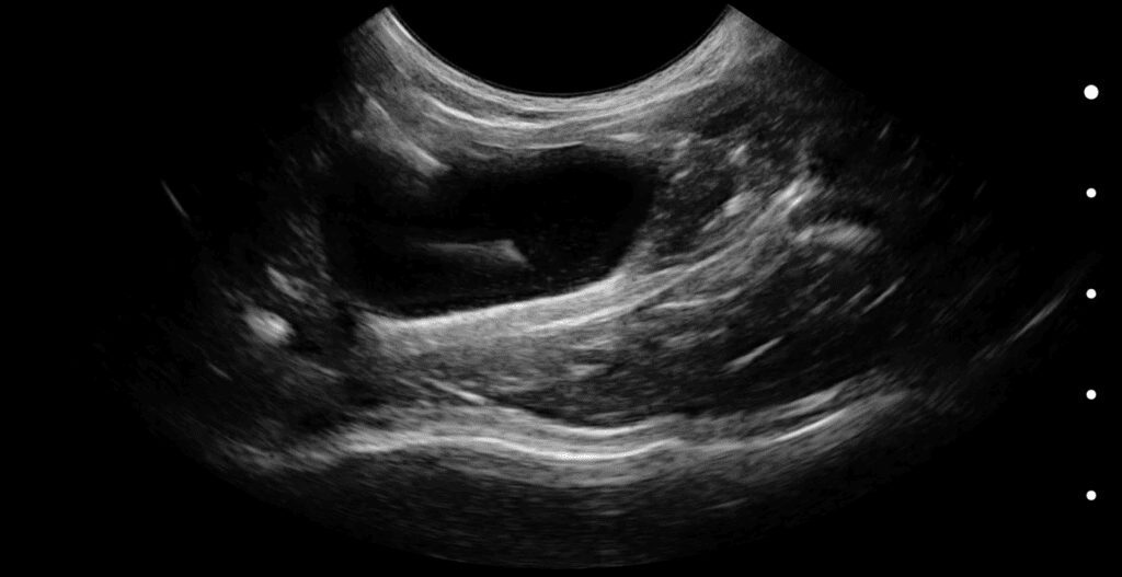 Ultrasound image showing sediment within the urinary bladder