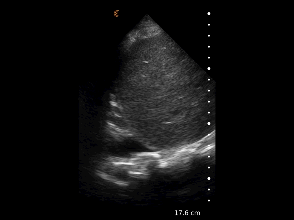 Ultrasound image showing right pleural effusion with clear delineation of fluid accumulation in the pleural space.