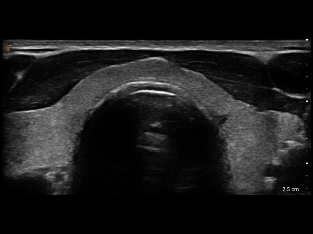 Ultrasound image showing the thyroid isthmus with detailed visualization of surrounding neck anatomy.
