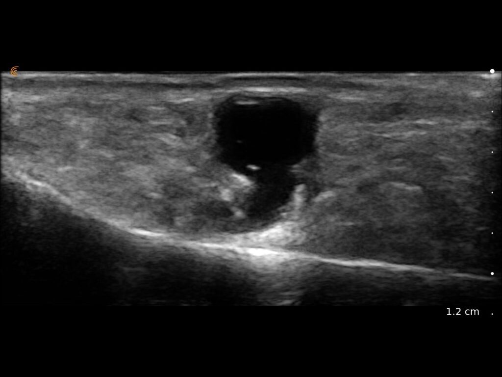 Ganglion cyst imaged in the forefoot with clear visualization of surrounding soft tissue structures