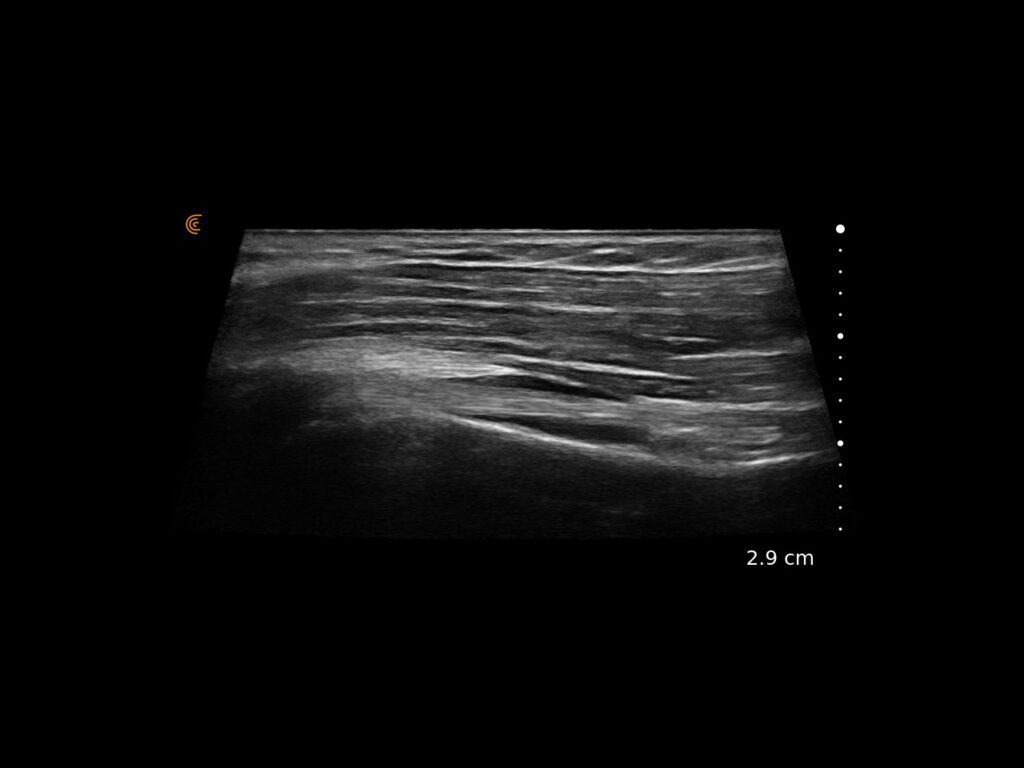 Long-axis ultrasound view of the biceps tendon with overlying trapezoid muscle clearly visualized