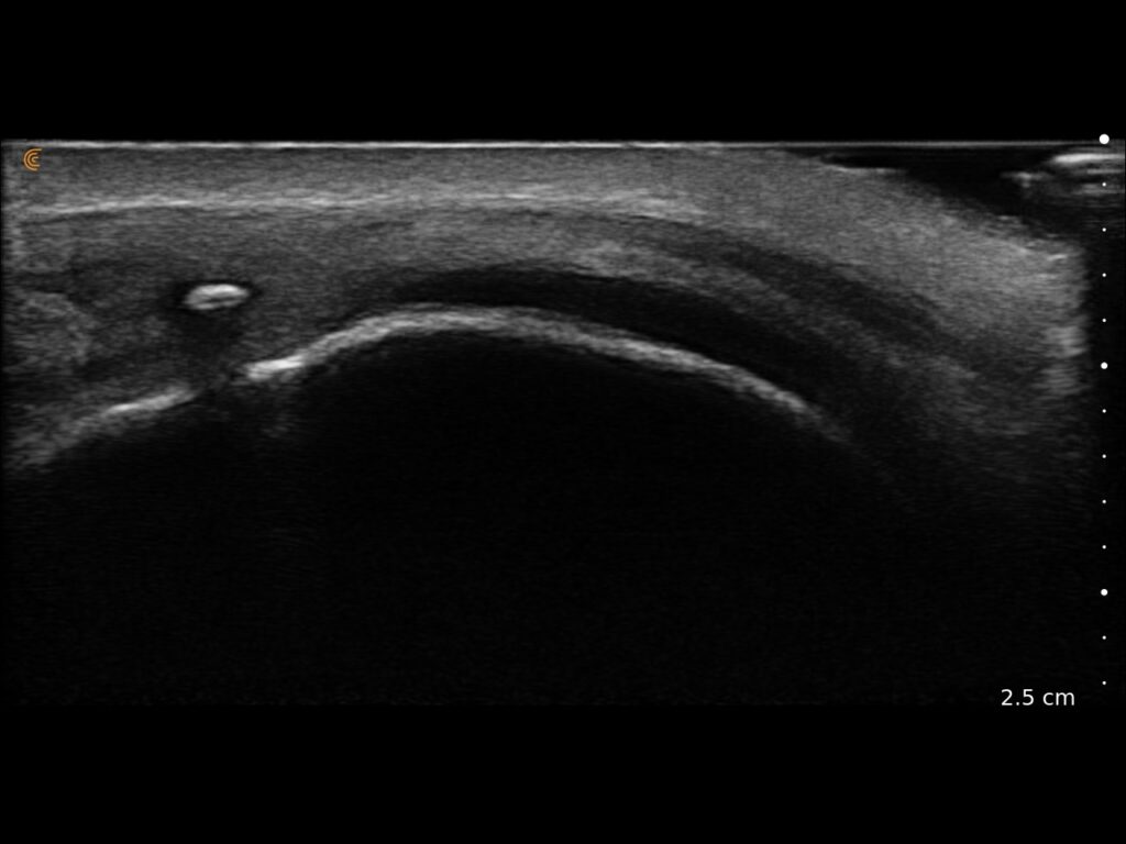 Calcification visualized within the quadriceps tendon on longitudinal musculoskeletal ultrasound