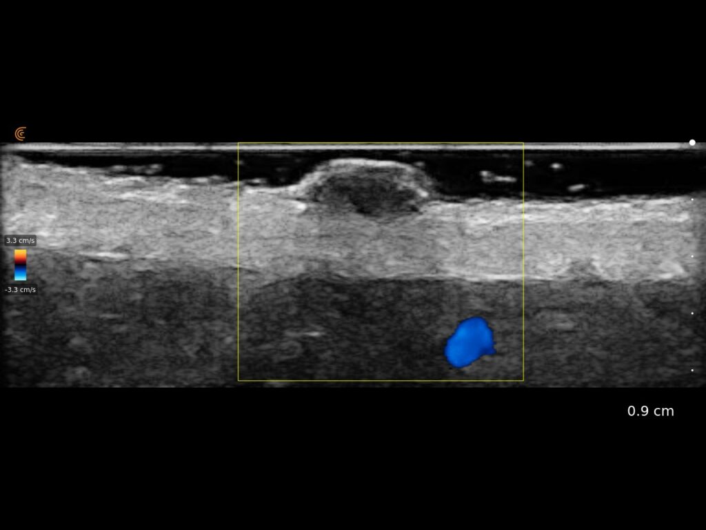 Ultrasound image of a pigmented skin nevus with color Doppler highlighting vascularity for lesion assessment.