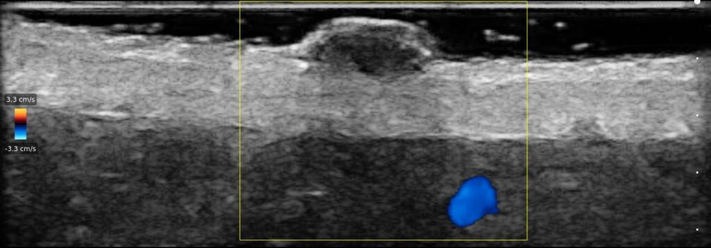 Ultrasound image of a pigmented skin nevus with color Doppler highlighting vascularity for lesion assessment.