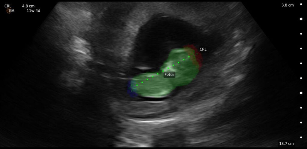 Ultrasound image showing 11-week fetus with crown-rump length measured using OB AI for early pregnancy assessment.
