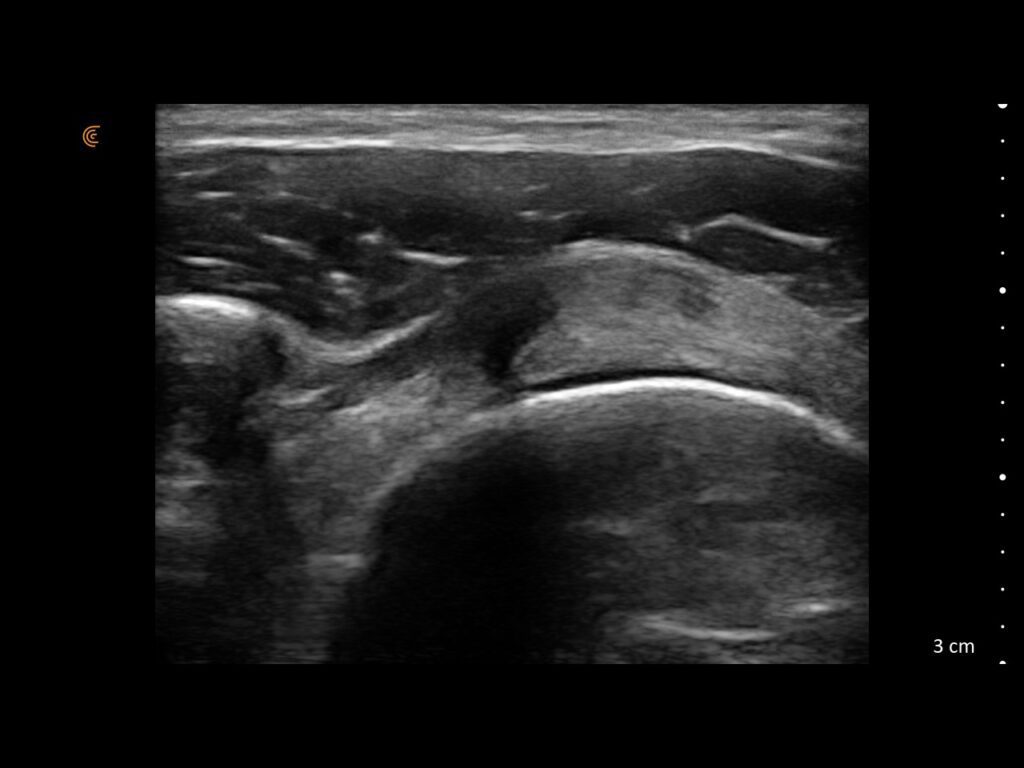 Long-axis ultrasound image of the supraspinatus tendon showing a hypoechoic defect consistent with a tear.
