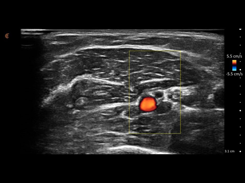 Transverse view of a neurovascular bundle with color Doppler highlighting arterial flow adjacent to the nerve