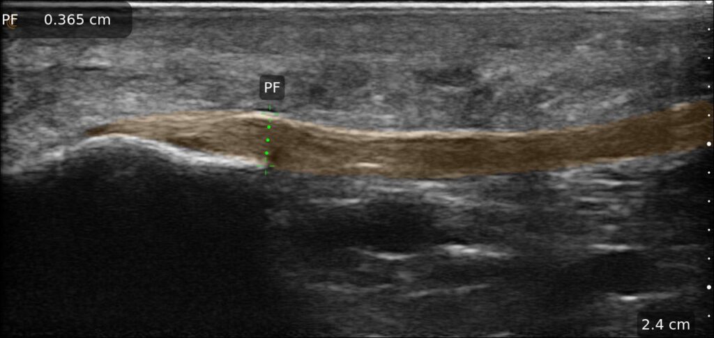 Plantar fascia imaged with AI to evaluate thickness and tissue condition
