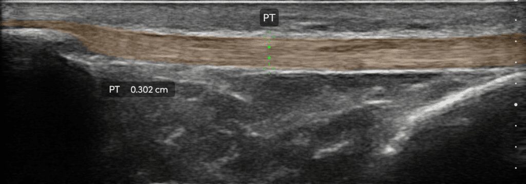 Patellar tendon visualized with AI to assess tendon structure and integrity