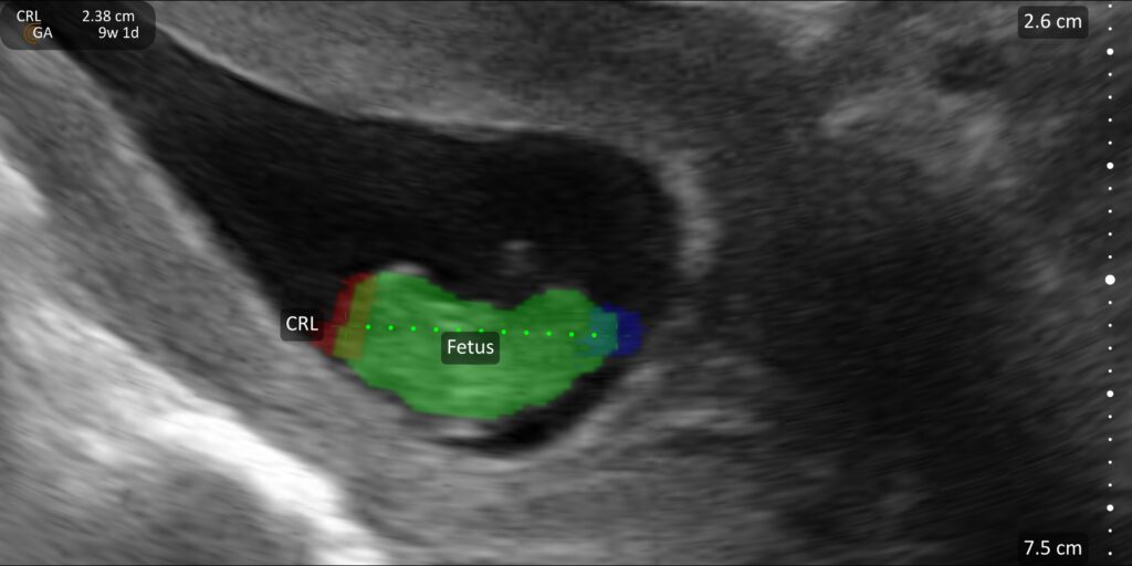 Crown-rump length measurement with OB AI for first trimester fetal assessment
