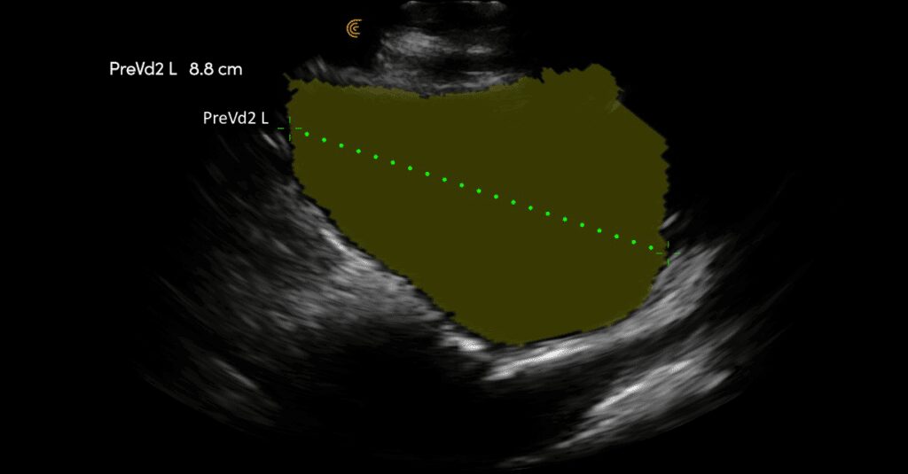 Longitudinal bladder view with AI for volume assessment