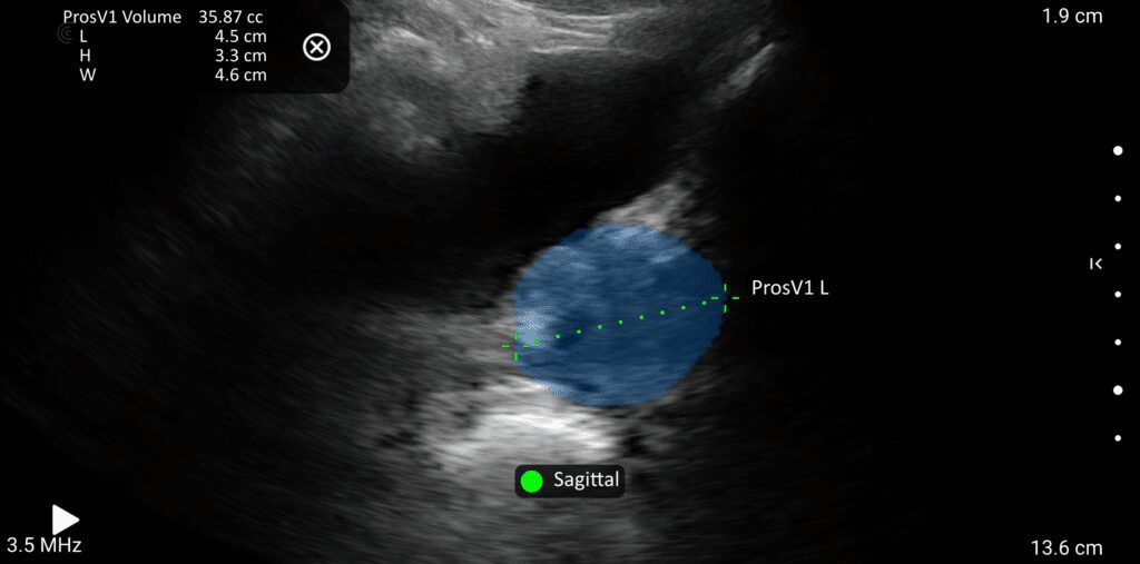 Sagittal view of prostate with AI overlay for gland assessment and measurement