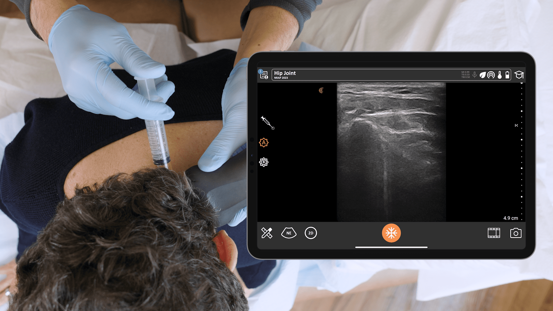 Levelon Injaction Ultrasound-Guided PRP Injection at the Level of C2 | Clarius